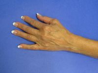 1648516-HandPre-op1.jpg