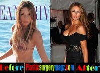 2508282-Melania-Trump-Plastic-Surgery-Boob-Job.jpg